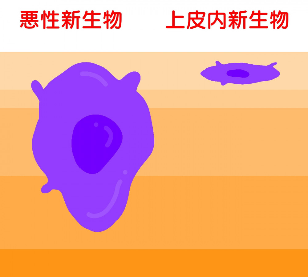 イメージ：がん悪性新生物（悪性腫瘍）と上皮内がん（上皮内新生物）の違い
